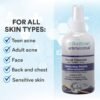 SkinSmart Facial Cleanser for Acne, Targets Bacteria for Active Teenage Athletes Post Workout and Adult Acne, 8 oz Spray Bottle, Safe for Multiple Daily Uses