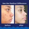 PanOxyl 10% Acne Foaming Wash 5.5 Ounce (Pack of 1)