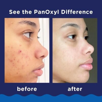 PanOxyl 10% Acne Foaming Wash 5.5 Ounce (Pack of 1)